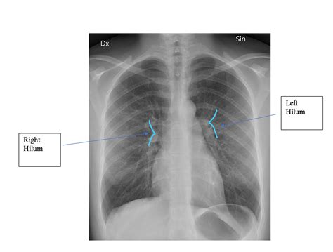 longhili|The Pulmonary Hilus and Lung Cancer